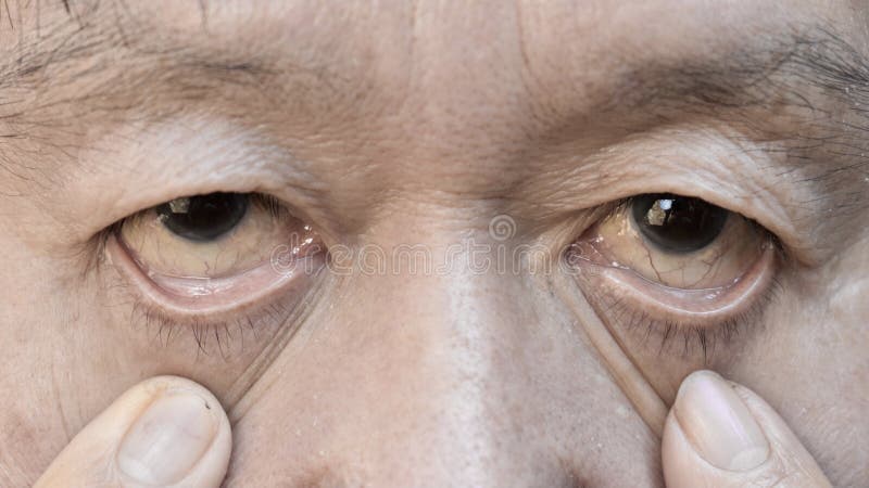 Mucosas hipocoradas é um sinal de anemia